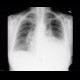 Lymphangitic carcinomatosis, fluidothorax: X-ray - Plain radiograph